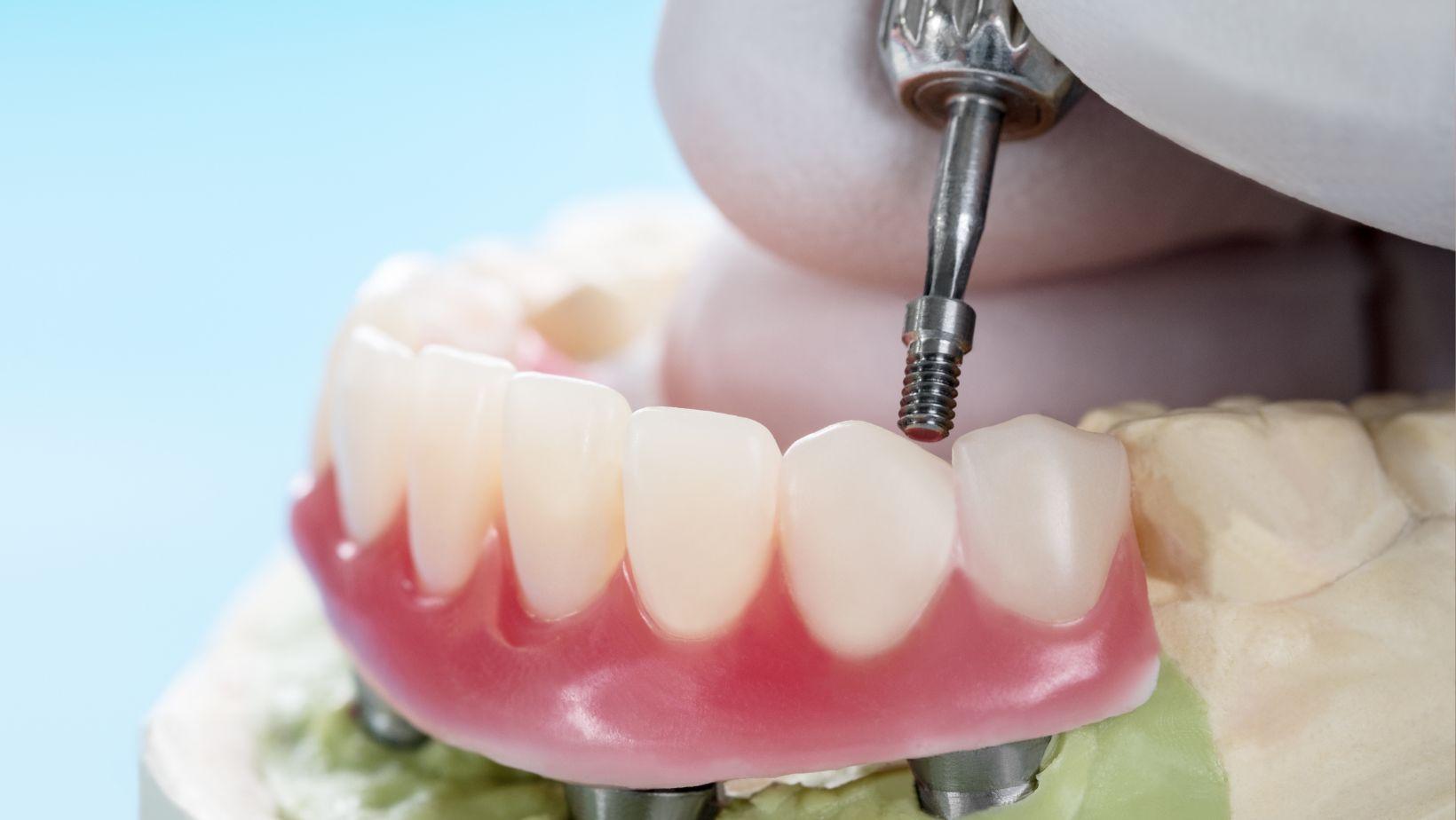 implant-supported dentures lower jaw, lower jaw denture stabilization, implant dentures benefits, full mouth rehabilitation implants, dental implants for lower jaw, stable denture solutions, affordable implant dentures, best implant supported dentures, upper lower jaw implant options