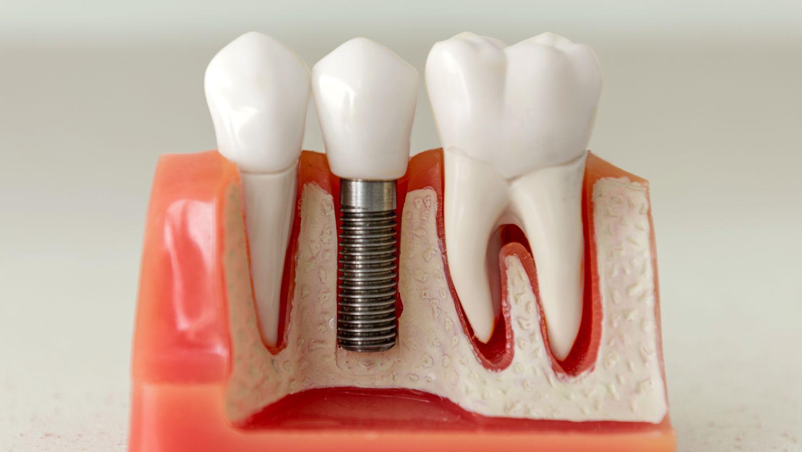 mini dental implants, traditional dental implants, dental implant comparison, benefits of mini implants, implant costs, implant recovery time, mini vs traditional implants, dental implant benefits, affordable dental implants, implant surgery recovery