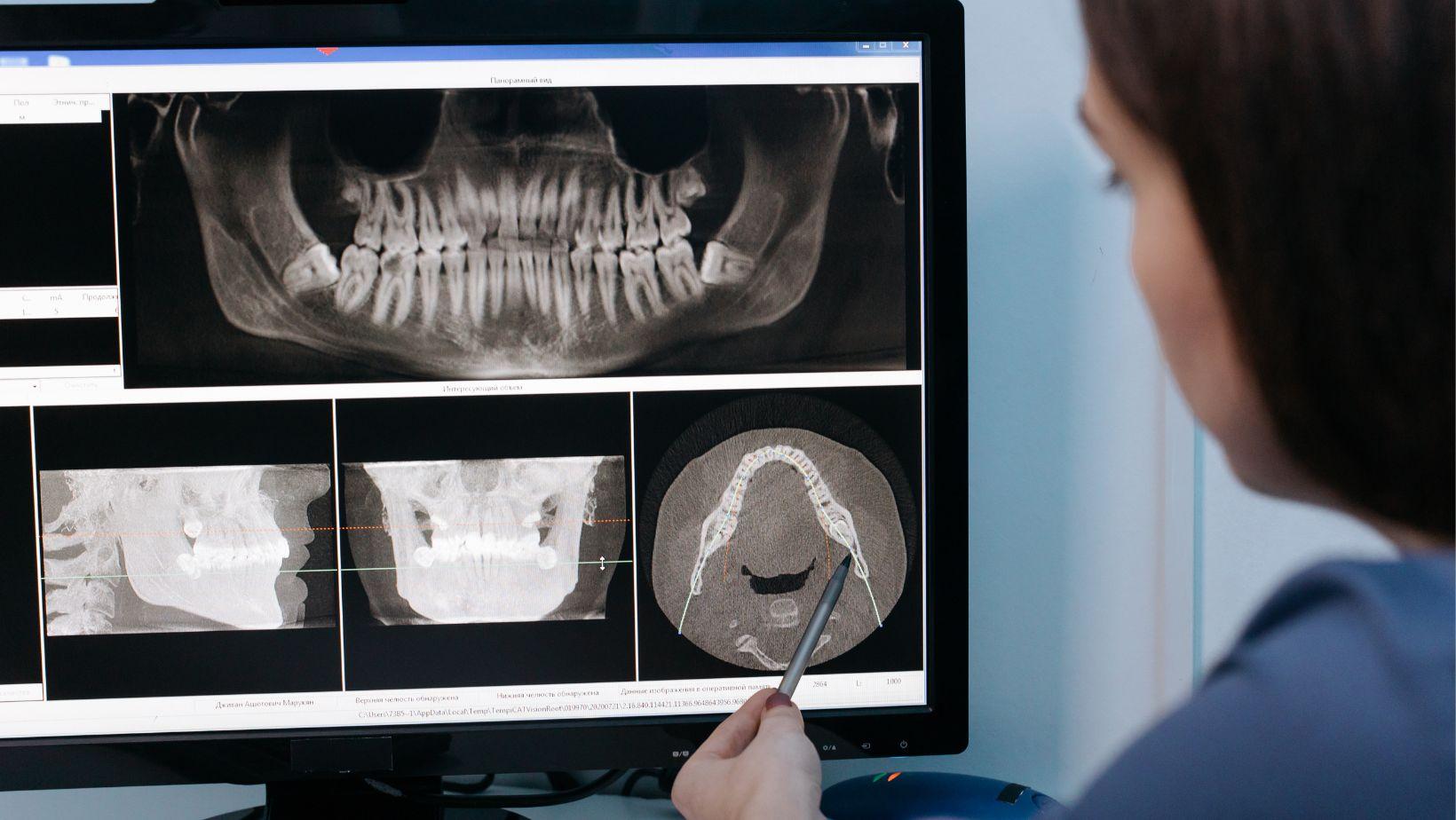 zygomatic dental implants, severe bone loss treatment, upper jaw rehabilitation, zygomatic implants cost, zygomatic implants specialists, bone loss dental solutions, zygomatic implants procedure, upper jaw reconstruction, implant dentistry solutions, bone loss dental implants
