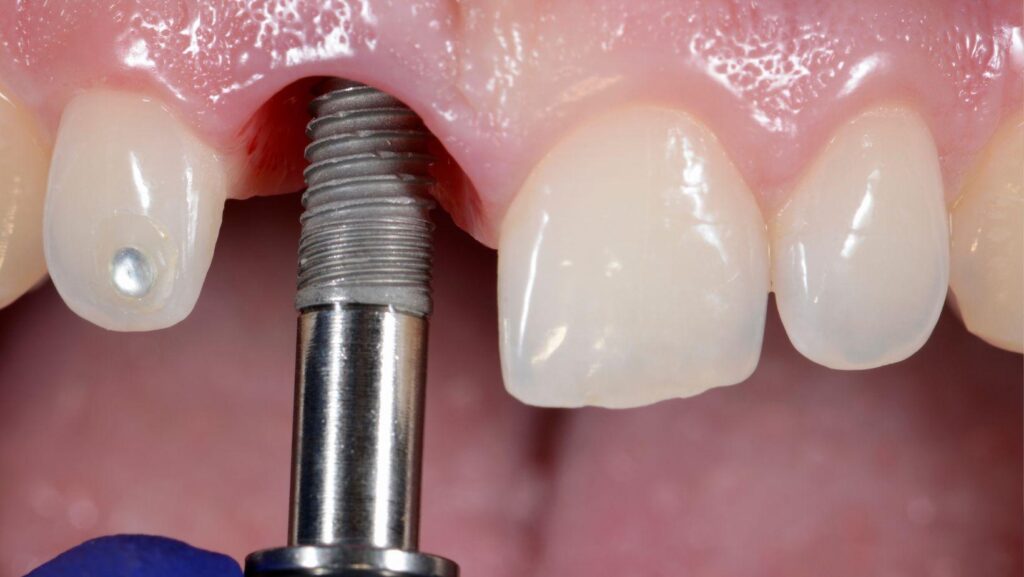 dental implant healing timeline, implant recovery week by week, dental implant post-surgery, dental implant healing process, dental implant recovery expectations, dental implant healing stages, dental implant aftercare, dental implant surgery recovery, dental implant healing guide