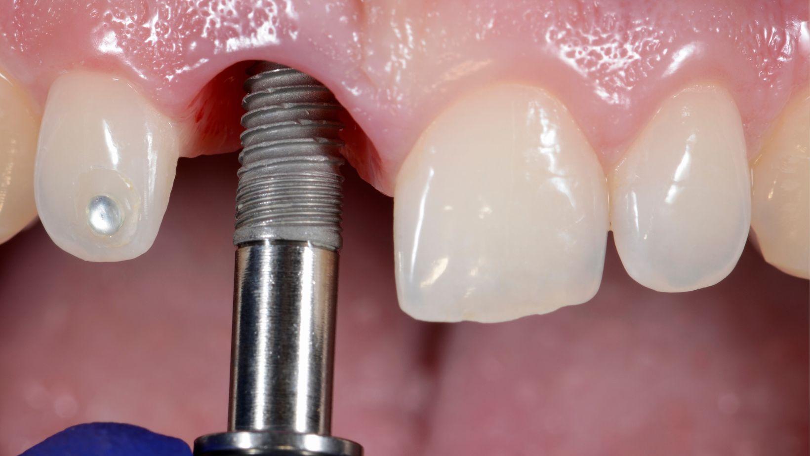 dental implant healing timeline, implant recovery week by week, dental implant post-surgery, dental implant healing process, dental implant recovery expectations, dental implant healing stages, dental implant aftercare, dental implant surgery recovery, dental implant healing guide